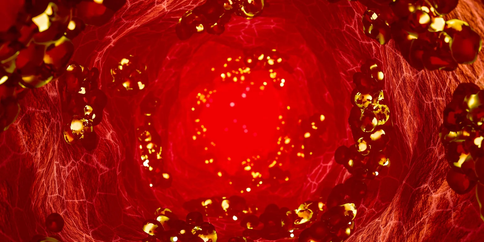 pis xolesterin, LDL xolesterin, gen redaktəsi, CRISPR, bir iynə ilə müalicə, ANGPTL3, ürək-damar xəstəlikləri, yeni müalicə